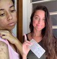 Brasileira usa redes sociais para mostrar sua batalha contra a acne severa  Foto: Reprodução / Instagram / @_dudaalemes / Reprodução / Instagram / @_dudaalemes