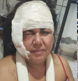 Empresária leva mais de 60 pontos no rosto e quebra braço em acidente de moto   Foto: Arquivo Pessoal 