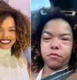 Jeniffer Nascimento sofreu com alergia  Foto: Reprodução/Instagram 