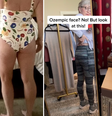 "Bunda de Ozempic" e queda de cabelo: mulheres relatam efeitos colaterais  Foto: Reprodução Redes Sociais / Tik Tok / Reprodução Redes Sociais / Tik Tok