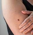 Pintas e manchas escuras na pele exigem atenção médica  Foto: Shutterstock / Alto Astral
