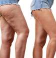 Sofre de lipedema e varizes? Saiba por onde começar o tratamento  Foto: Shutterstock / Saúde em Dia