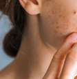 Saiba como não errar no tratamento para acne  Foto: Shutterstock / Alto Astral
