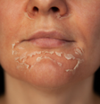 Proteja-se O que você precisa saber sobre o peeling de fenol  Foto: Sou Mais Bem Estar