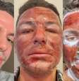 Peeling de fenol é uma técnica agressiva e que demanda extrema cautela  Foto: Reprodução / Instagram / @joaocastroph / Alto Astral