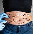 Cirurgião plástico responde 5 dúvidas sobre a abdominoplastia  Foto: Shutterstock / Saúde em Dia
