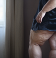 Lipedema  Foto: Sou Mais Bem Estar