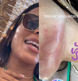 Anitta relata ter sofrido ataque de água-viva durante passeio em Ibiza  Foto: Reprodução/Instagram/@anitta