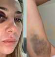 Ex-primeira-dama da Argentina mostra hematomas após agressões de Fernández: 'Você me bate há 3 dias'  Foto: Reprodução/Infobae