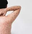 A mpox é uma doença zoonótica viral  Foto: Canva Fotos / Perfil Brasil