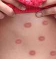 Nos Estados Unidos, durante uma epidemia anterior de mpox, a FDA, agência norte  Foto: americana para a Alimentação e Medicamentos, autorizou o uso emergencial da vacina para adolescentes -  Canva Fotos / Perfil Brasil