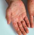 A mpox é uma doença viral que causa lesões na pele  Foto: Shutterstock / Alto Astral