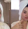 Virgínia Fonseca revela escurecimento de manchas de acne após parto de José Leonardo e médica revela como diminuí-las.  Foto: Instagram, @virginia / Purepeople