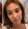 Vanessa Lopes mostra evolução de tratamento da acne. À esquerda, como era antes, e à direita, como ficou depois.  Foto: Reprodução/Instagram
