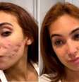 Antes e depois de Vanessa Lopes - Reprodução/Instagram  Foto: Márcia Piovesan