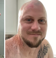 O norte-americano John Pendleton sofreu queimaduras de terceiro e quarto graus em 30% da parte superior do corpo; hoje ele ajuda pessoas a compartilharem suas histórias e lidarem com traumas  Foto: Reprodução/Redes Sociais