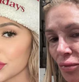 Ex-modelo, Brandi Glanville mostra rosto 'derretido': 'Dizem que tem um parasita'  Foto: Reprodução/ Instagram / Contigo