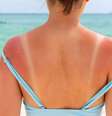 As queimaduras solares são uma das queixas mais comuns do verão  Foto: Shutterstock / Alto Astral