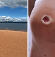 Ao todo, seis banhistas foram mordidos por piranhas  Foto: Reprodução/Prefeitura de Itirapina/Arquivo pessoal obtido pelo G1 São Carlos