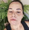 Mariana Michelini perdeu os lábios após harmonização com substância proibida  Foto: Reprodução/Instagram