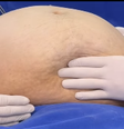 Médico retira cisto de quase 8 kg de paciente em hospital: ‘Foi um dos maiores que já removi’  Foto: Reprodução/Instagram