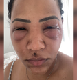 ‘Meu olho estava enorme’: mulher tem infecção grave após erro em aplicação de ácido hialurônico nas olheiras  Foto: Reprodução/Arquivo Pessoal