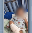 Heitor Gustavo Ribeiro havia sido internado inicialmente no Hospital Materno-Infantil Dr. Joaquim Sampaio, em Ilhéus (BA), mas desenvolveu uma infecção grave que levou à necrose do membro  Foto: Reprodução/TV Bahia