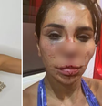 Influenciadora francesa fica desconfigurada após sofrer ataque brutal por homens armados  Foto: Reprodução/Redes sociais