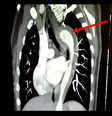 Tomografia feita no tórax da paciente revela o hematoma intramural da aorta torácica  Foto: Reprodução/American Journal of Case Reports