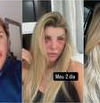 Antes e depois da ex-BBB Íris Stefanellli após lifting facial  Foto: Reprodução/Instagram