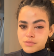 Larissa de Jesus dos Santos pegou infecção após mosca entrar em seu olho  Foto: Reprodução/larissasantosj__/Instagram