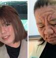 Mulher mostrou antes e depois da acne gravídica afetar seu rosto  Foto: Reprodução/TikTok