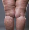 Lipedema: saiba os sintomas e como diferenciar de outras questões  Foto: Foto? Shutterstock / Saúde em Dia