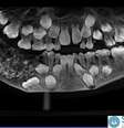 Exame de imagem mostra má-formação na dentição de garoto com odontoma composto  Foto: Saveetha Dental College and Hospital / Divulgação