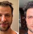 Ex-BBB Gustavo Marsengo mostra resultado 9 meses após ter feito transplante capilar: ‘Um novo homem’  Foto: Reprodução/Instagram