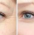 Como evitar rugas e outros problemas na região dos olhos?  Foto: Shutterstock / Saúde em Dia