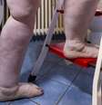 Embora os primeiros relatos da doença sejam datados dos anos 1940, apenas em 2022 o lipedema passou a ter um código próprio no Cadastro Internacional de Doenças (CID)  Foto: Picture alliance / Getty Images