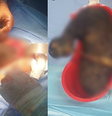 Adolescente diagnosticada com 'síndrome de Rapunzel' tem bola gigante de cabelo removida do estômago  Foto: Divulgação