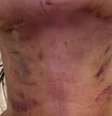Pacientes tiveram lesão grave após realizar lipoaspiração de papada e lifting facial, procedimentos cirúrgicos que removem o excesso de pele e gordura da região do pescoço  Foto: Reprodução/TV Sudoeste