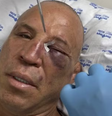 Wanderlei Silva mostrou resultado da luta com Popó  Foto: Reprodução/Instagram/Wanderlei Silva