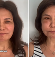 Mulher tem reação alérgica a ácido hialurônico mais de um ano após preenchimento: ‘Acordei desse jeito’  Foto: Reprodução/Instagram