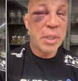 ‘Dois dias e o olho ainda não abriu’, diz Wanderlei Silva  Foto: Reprodução/Instagram