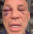 Wanderlei Silva apareceu com o olho bastante inchado em um novo vídeo sobre seu estado de saúde  Foto: Reprodução/Instagram