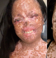 Juliana Flores descreve rotina com xeroderma pigmentoso: 'sair de casa só à noite'  Foto: Arquivo pessoal