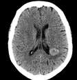 Um caso de 1997 choca os cientistas até os dias atuais, pois uma mulher passou a afirmar que vozes lhe contavam que ela tinha um tumor  Foto: Reprodução/YouTube / Bons Fluidos