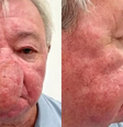 Escocês com nariz gigante se submete a cirurgia para reparar condição rara  Foto: Reprodução/Ever Clinic