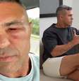 Vitor Belfort mostra rosto inchado após procedimento e faz comentário  Foto: Reprodução/Instagram / Famosos e Celebridades