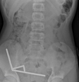 Raio-x mostra ímãs no intestino de garoto na Nova Zelândia  Foto: Reprodução/New Zealand Medical Journal