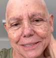 Roseana Sarney conta que assumiu a careca durante o tratamento contra o câncer  Foto: Reprodução/Instagram/@roseanasarney