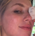 Virgnia aparece com lesão no olho após acidente com Maria Flor  Foto: Reprodução/Instagram @virginia